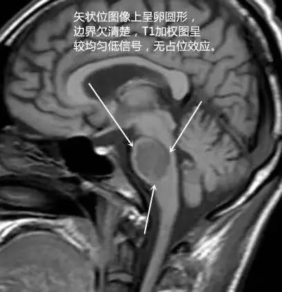 脱髓鞘病变是什么病怎么读,脱髓鞘病变的特征