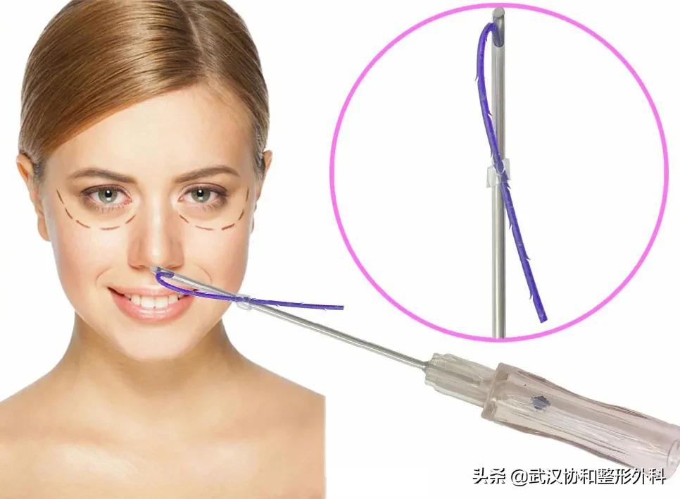 线雕隆鼻的副作用和危害,线雕隆鼻费用一般多少钱