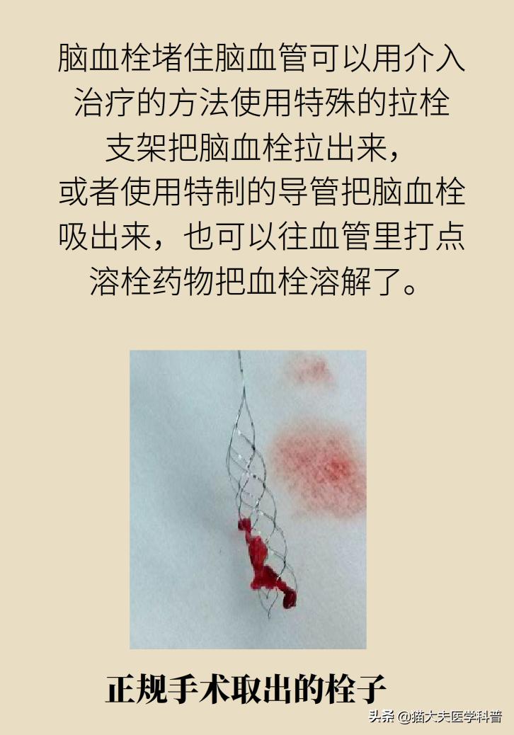 不手术能彻底治好血栓外痔吗,介入治血栓最好的方法