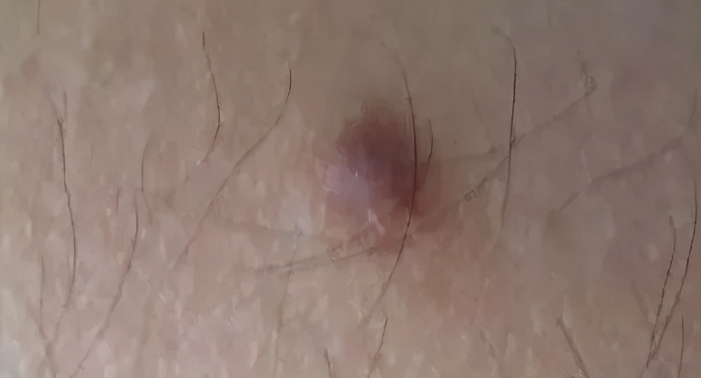 脸上长了闭口小颗粒怎么去除,脸上白色颗粒怎么去除