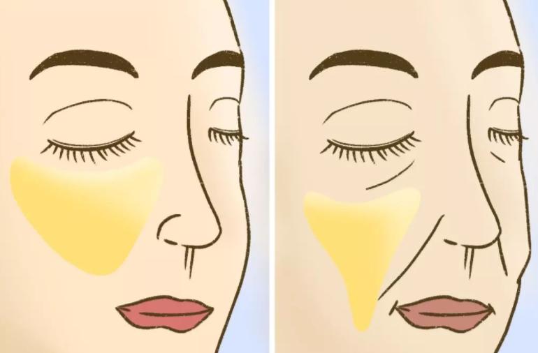 女人法令纹怎么运动改善,女人显老的法令纹