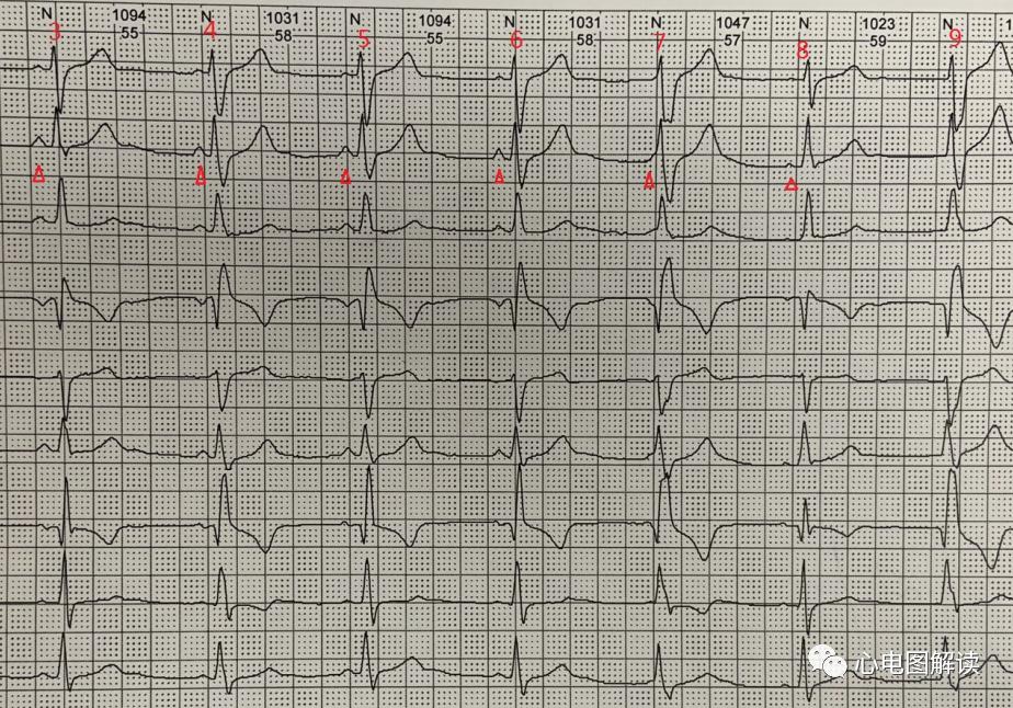 三度房室传导阻滞交界性逸搏,加速的室性逸搏心律的心电图表现