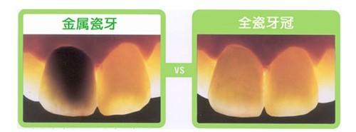 种植牙和烤瓷牙优缺点比较,种植牙和烤瓷牙的利与弊