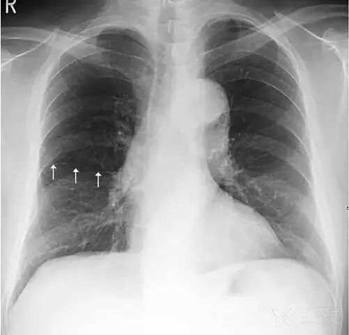 正常胸片图片,正常的胸片讲解