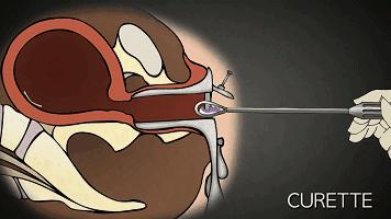 打胎有多可怕案例,20岁女生堕胎7次