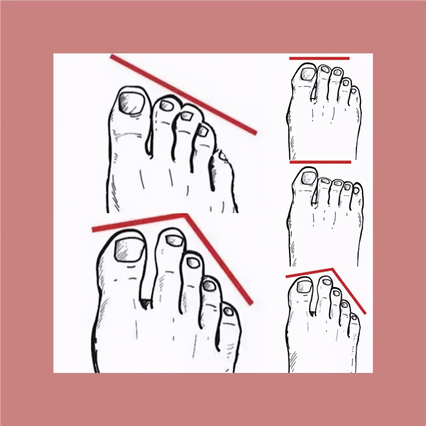 不同脚型适合的鞋子,鞋子不一定要贵只要合脚就行