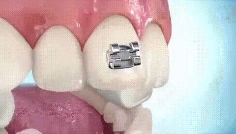 地包天戴牙套为什么牙套只戴上面,一个牙齿的牙套矫正的全过程
