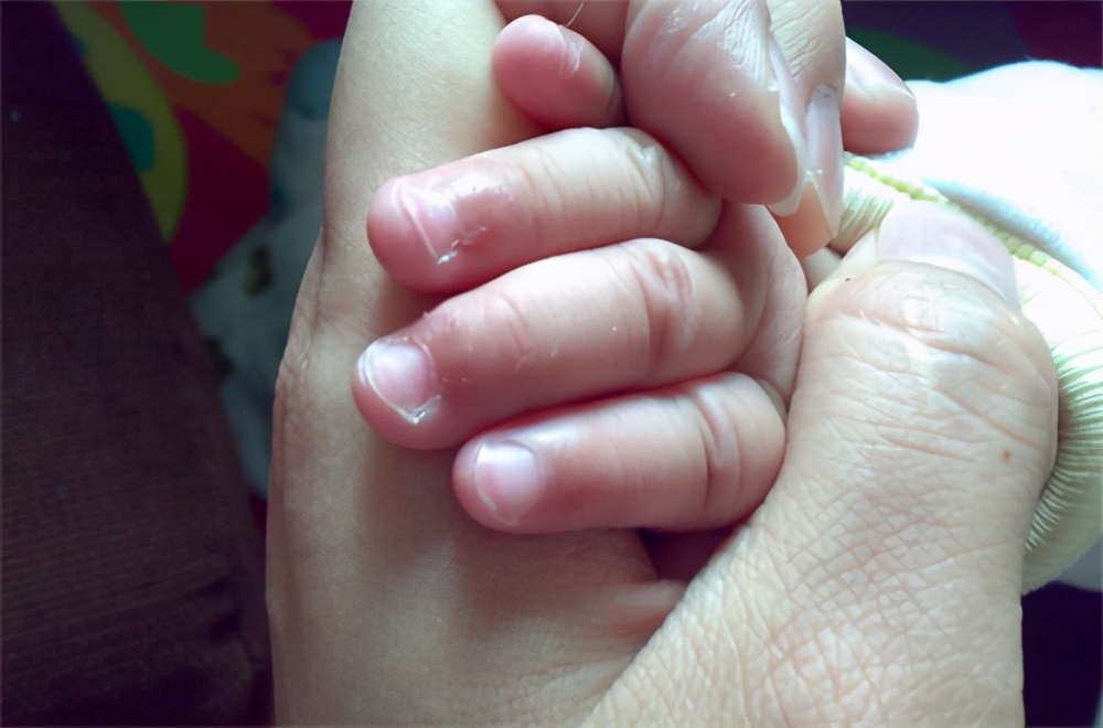 宝宝手上长倒刺家长千万别忽视,宝宝手上长倒刺妈妈要学会呵护