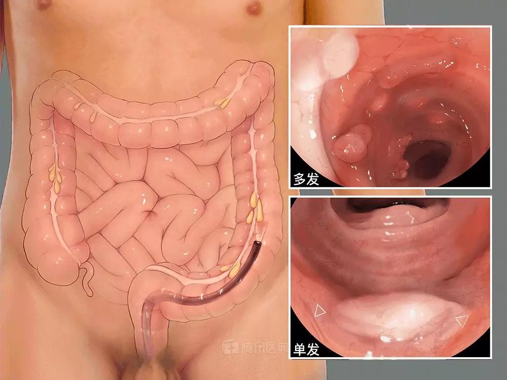 癌变的肉有哪些,身上长的肉赘会癌变吗