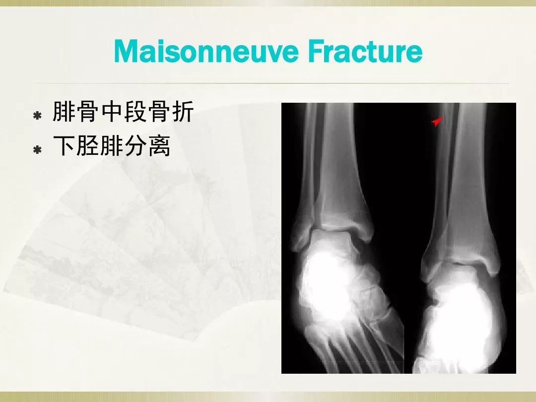 骨科x光片读片技巧,放射科骨科读片教程