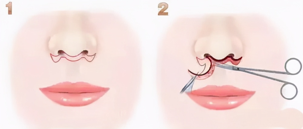 人中太短可以加长整形吗,人中过长有必要缩短吗