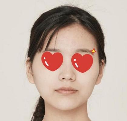 宽大又不对称脸型，被颧弓内推成功“拯救”