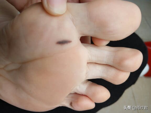 脚底长了个硬疙瘩病理检查恶性,脚底恶性肿瘤常见吗