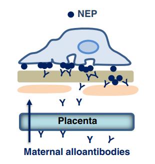 膜性肾病流行病学,膜性肾病的最新研究