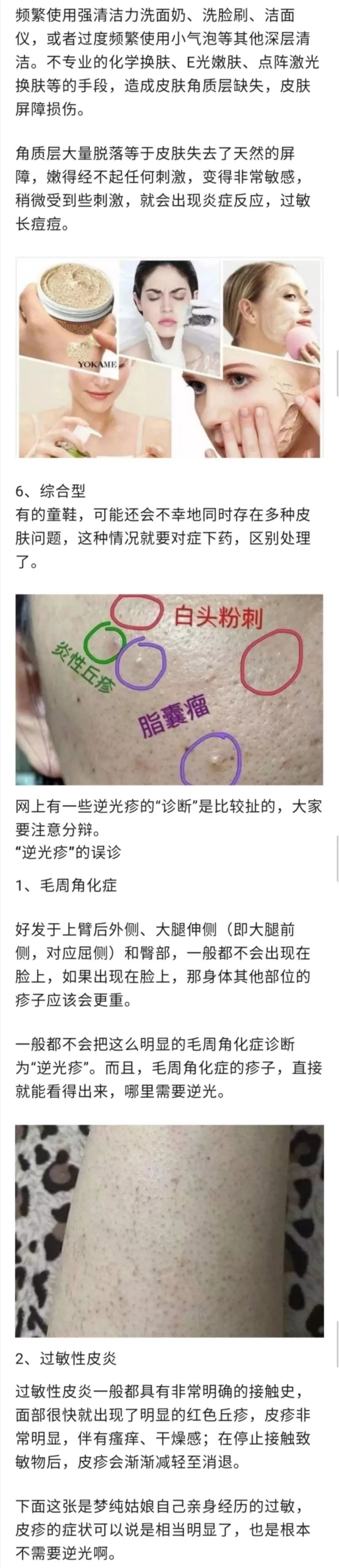 逆光疹是属于皮肤炎症吗,逆光疹是不是日光性皮炎