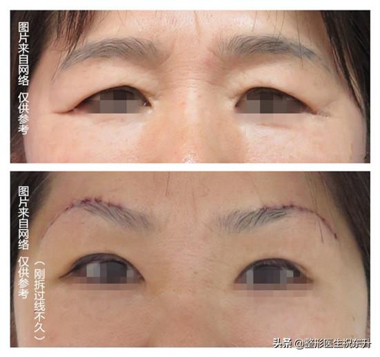 上睑松弛有什么解决办法,上睑皮肤松弛解决的方式有哪些