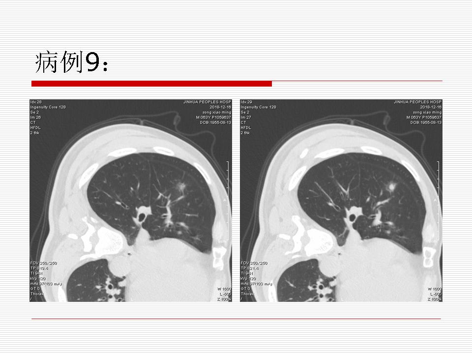 像炎症的肺癌能治好吗,医生说可能是肺癌也可能是炎症