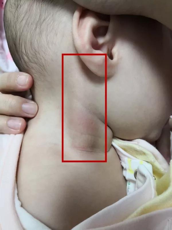 医生说孩子脖子歪了要做康复,三个月宝宝脖子老是歪向一边