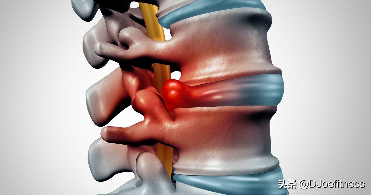 深蹲导致腰痛要停止训练吗,练习深蹲对腰酸背痛有疗效吗