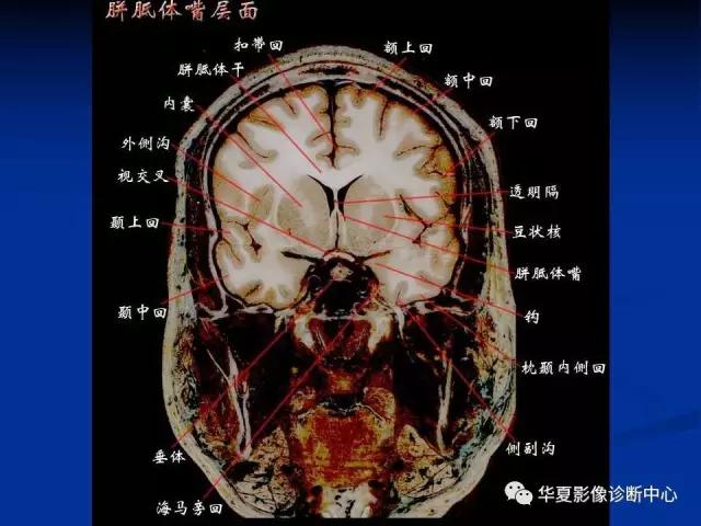 mra头颅解剖学详细讲解视频,常见的头颅mri图像