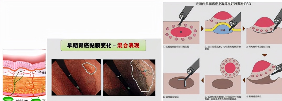 我不是药神，我不是财迷！若患胃癌，这些靶向药你有能力负担吗？