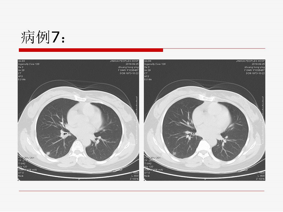 像炎症的肺癌能治好吗,医生说可能是肺癌也可能是炎症