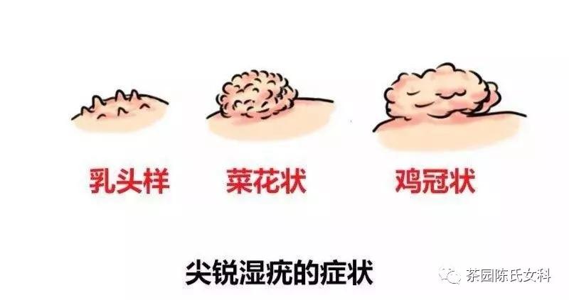 难缠的病——生殖器尖锐湿疣