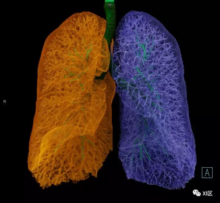如此详细的肺部影像解剖，有点儿酷