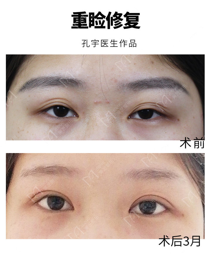 三角眼单眼皮怎么改善,三眼皮怎么改善成双眼皮