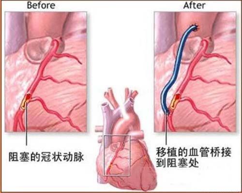糖尿病胸闷是并发症症状吗,糖尿病突然胸闷原因