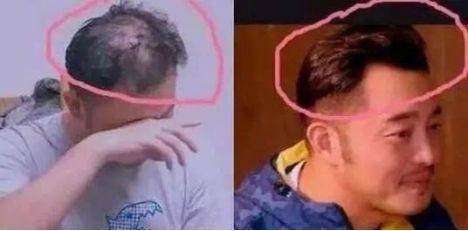 突如其来是什么原因引起的,突如其来的脱发