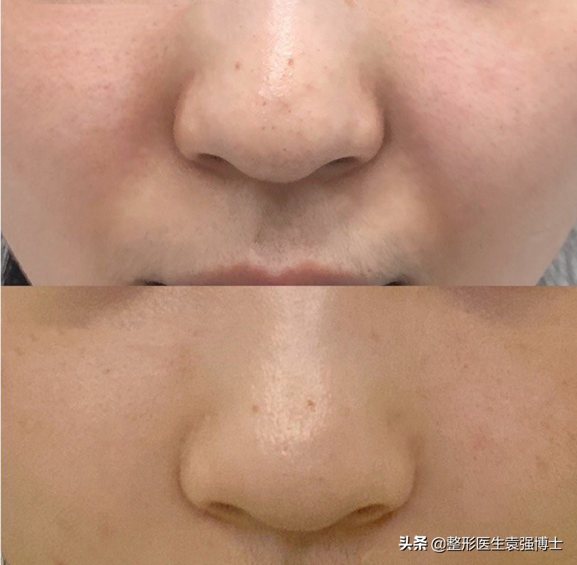 整形法令纹怎么去除最快最有效,整形医院可以去除法令纹吗