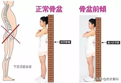 骨盆那些事儿：骨盆错位是女性疾病根源