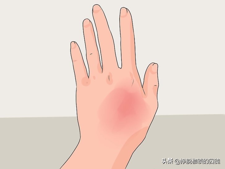 艾灸后出现水泡需要扎破吗,艾灸后起的水泡是排湿还是烫伤