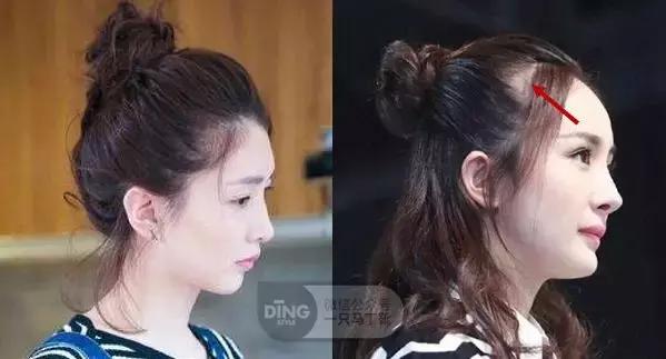 颅顶太低如何自救,颅顶低怎么自救