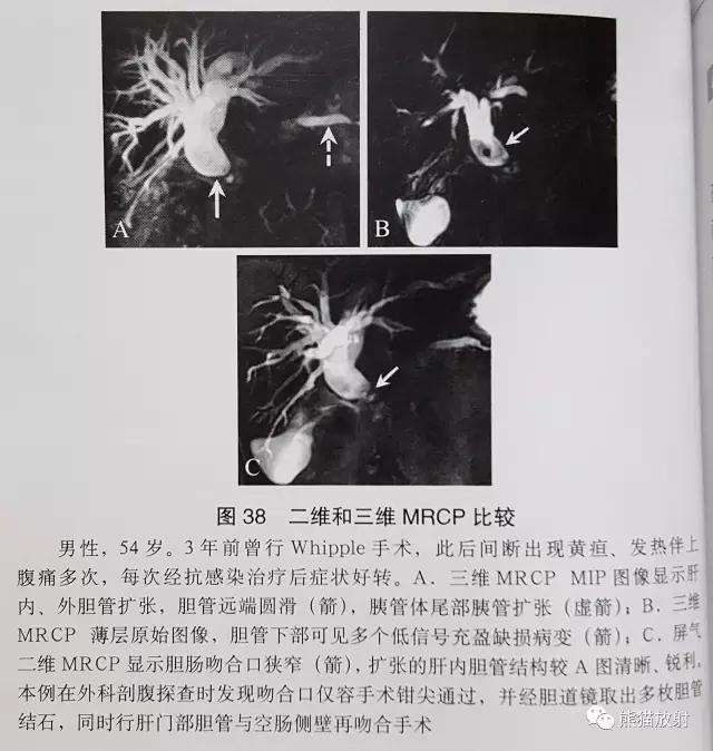 磁共振泌尿系水成像检查注意事项,磁共振影像基础知识讲解