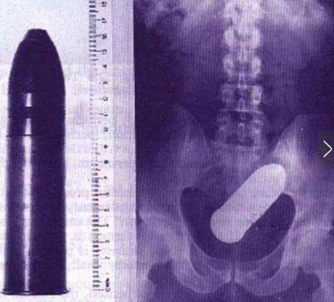 不作死就不会死，看看这些被人类搞进身体里的异物