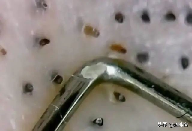 如何预防闭口长出并解决闭口问题,教你5个根治闭口粉刺方法