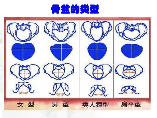 难产女性的骨盆,骨盆窄容易难产吗