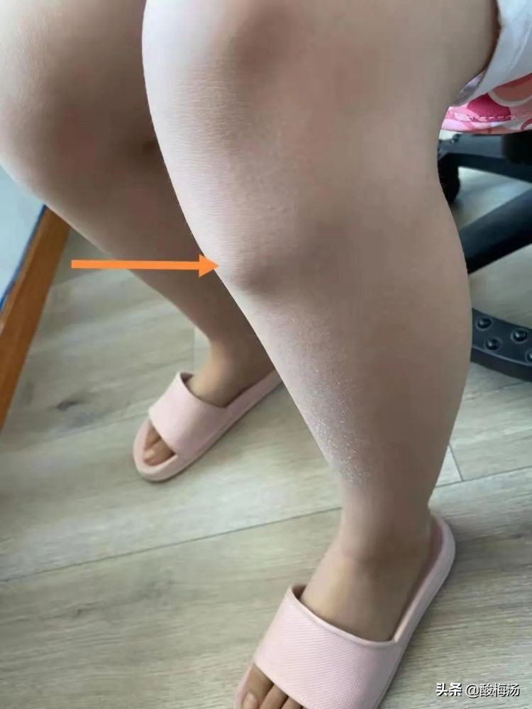 骨骺炎对运动有什么影响,儿童胫骨结节骨骺炎的严重后果