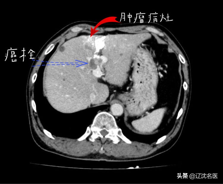 肝癌做放射性粒子治疗有什么影响,乏力查出来癌症