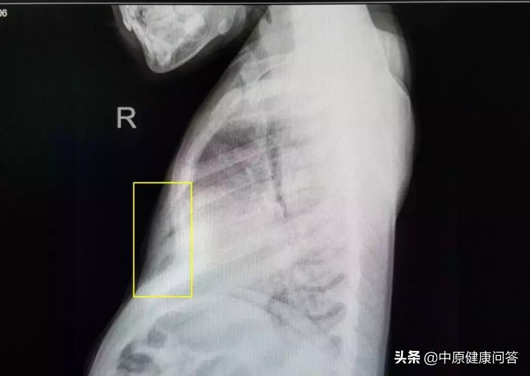 宝宝胸口凹陷地方青了,宝宝胸部凹下去一块是缺啥