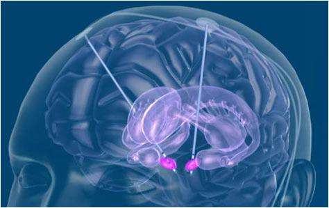 帕金森脑深部刺激手术后怎么恢复,脑深部电刺激能治愈帕金森吗