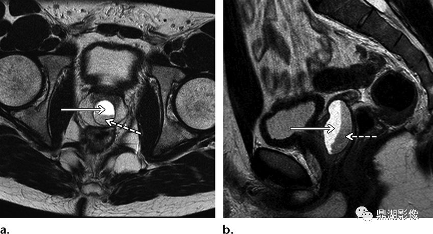 苗勒氏管囊肿在哪里,苗勒氏管囊肿是指什么