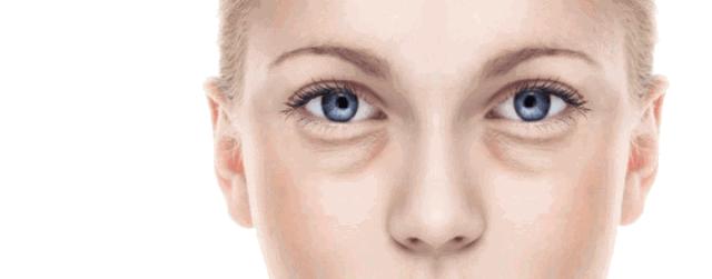 去眼袋15年后有细纹怎么办,祛眼袋之后会不会看着很平