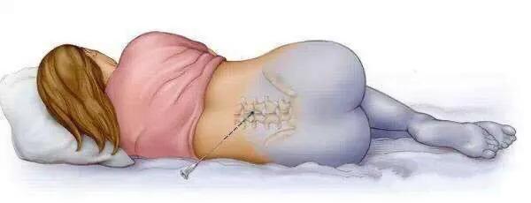 腰麻后是不是尾椎会疼,腰麻后脊椎骨会疼正常吗