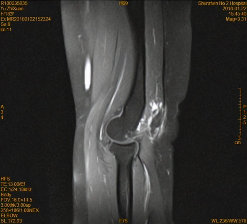 静脉畸形怎么办?介入栓塞是首选