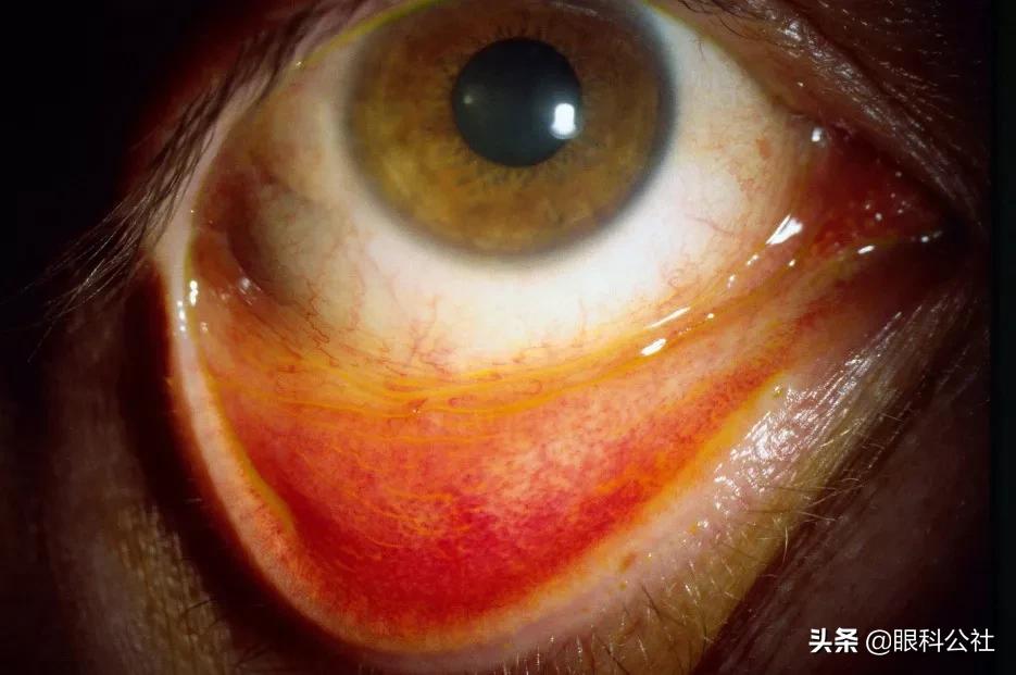 春季结膜炎的6大表现症状,疫情期间如何防结膜炎发生