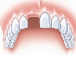 种牙缺颗门牙,种牙缺齿需矫正吗