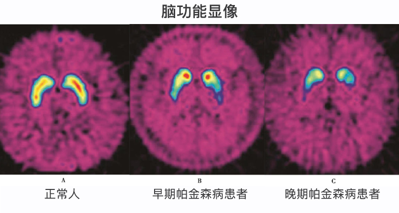 老年人手抖都是帕金森引起的吗,年轻人手抖记忆力差是不是帕金森